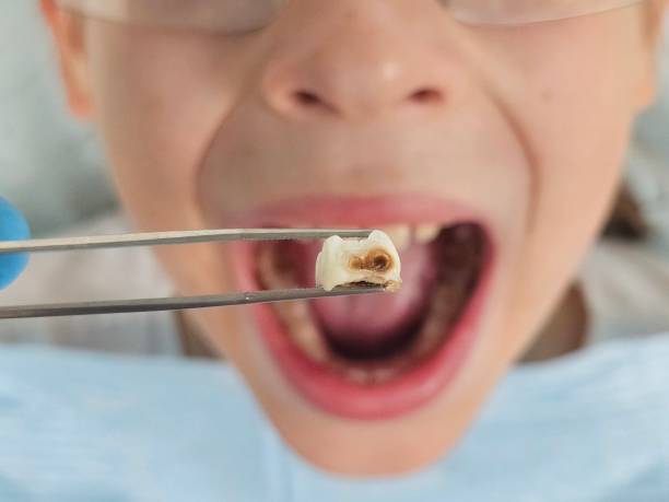 Best Walk-In Emergency Dentist in Ellington, MO